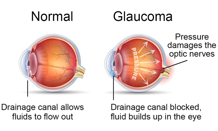 Normal eye and glaucoma